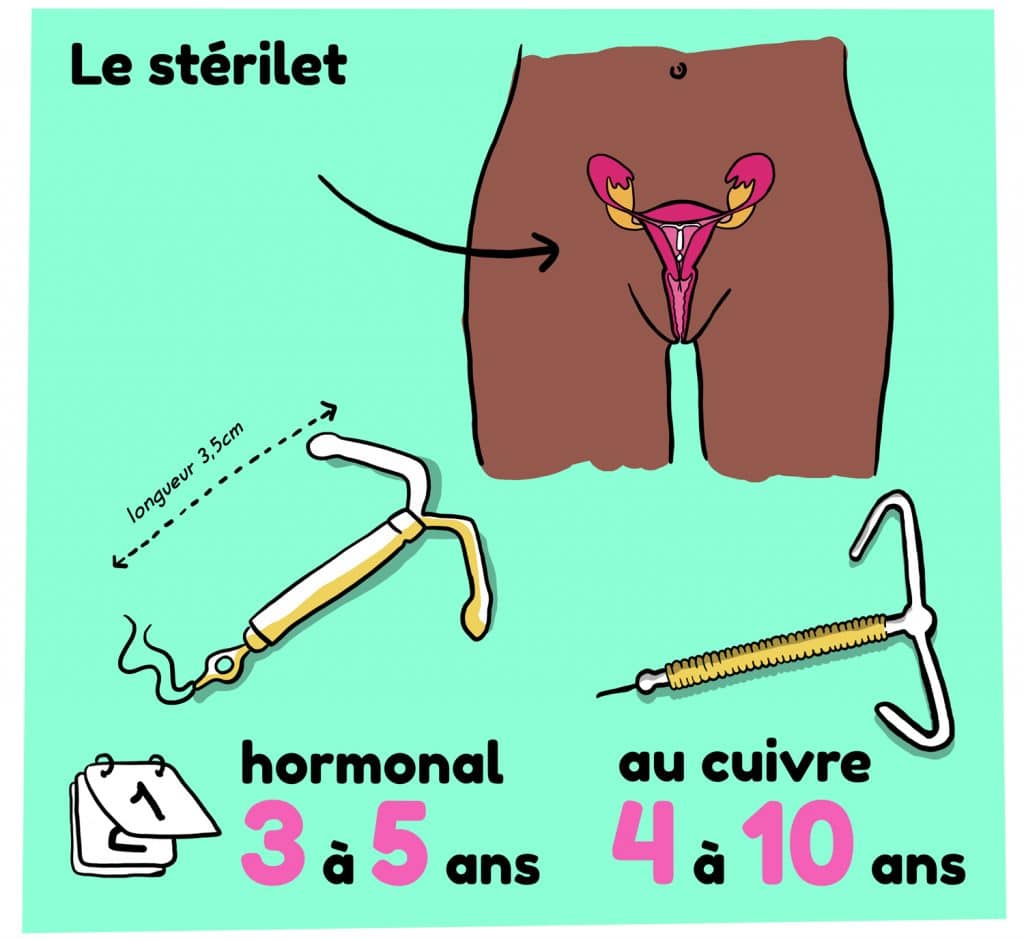 combien de temps dure un sterilet en cuivre